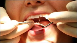 Scientists 'excited' by gel to repair tooth enamel